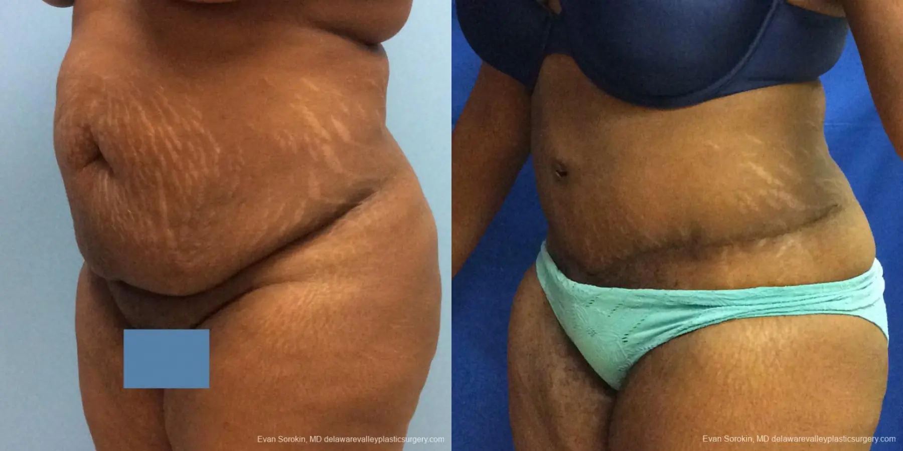 Philadelphia Abdominoplasty 10817 - Before and After 4