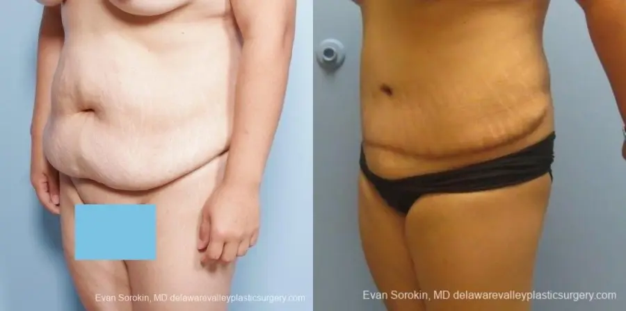 Philadelphia Abdominoplasty 8678 - Before and After 3