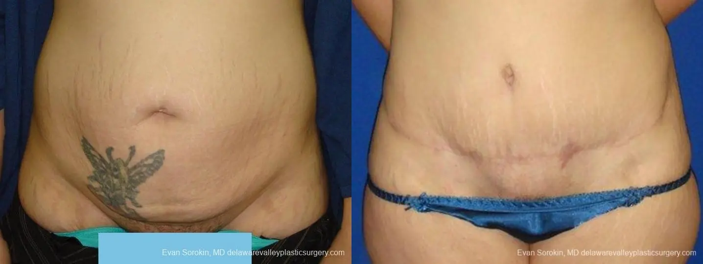 Philadelphia Abdominoplasty 9473 - Before and After 1