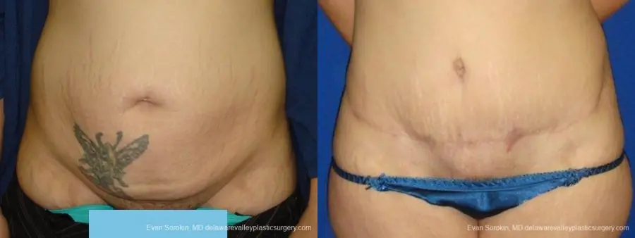 Philadelphia Abdominoplasty 9473 - Before and After 1