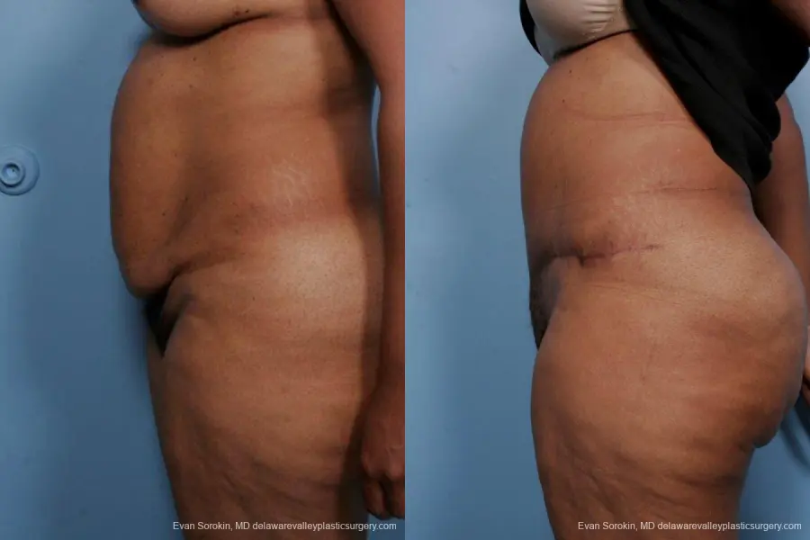 Philadelphia Abdominoplasty 9461 - Before and After 5