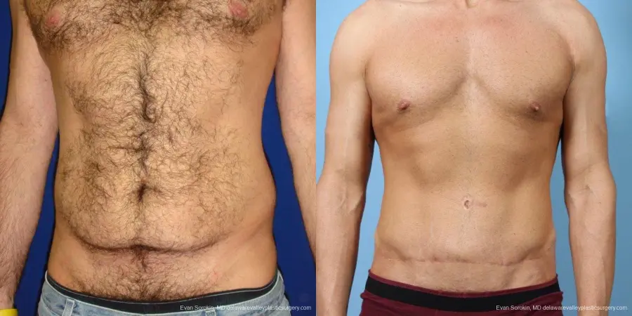 Philadelphia Abdominoplasty 9468 - Before and After