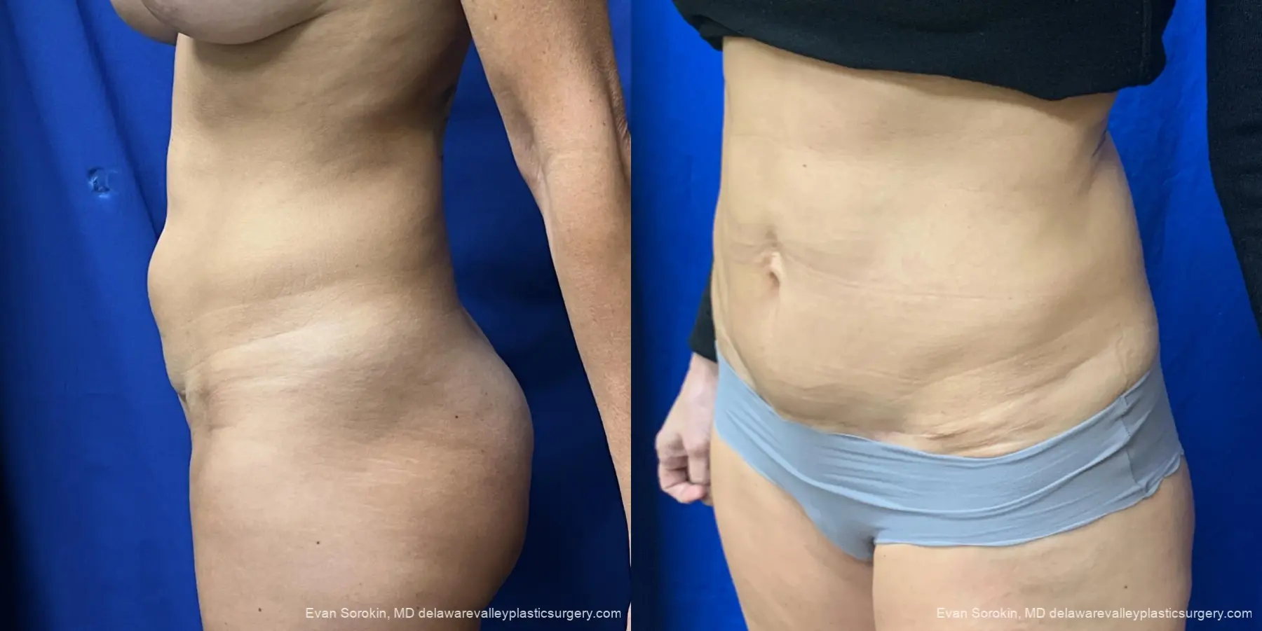 Abdominoplasty: Patient 46 - Before and After 5