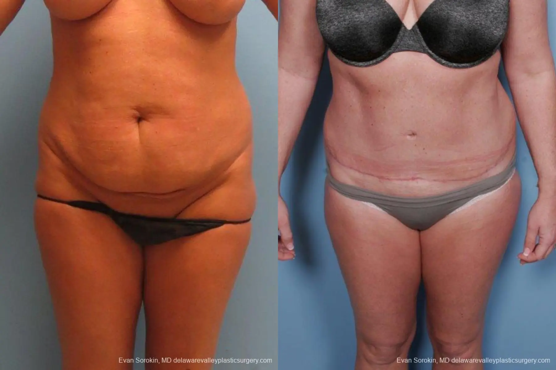 Philadelphia Abdominoplasty 9463 - Before and After