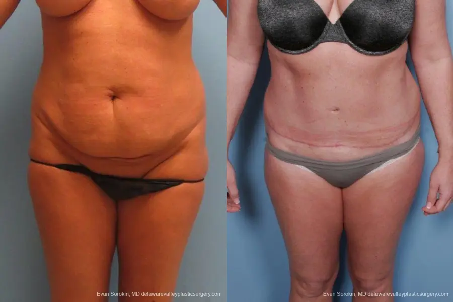 Philadelphia Abdominoplasty 9463 - Before and After 1