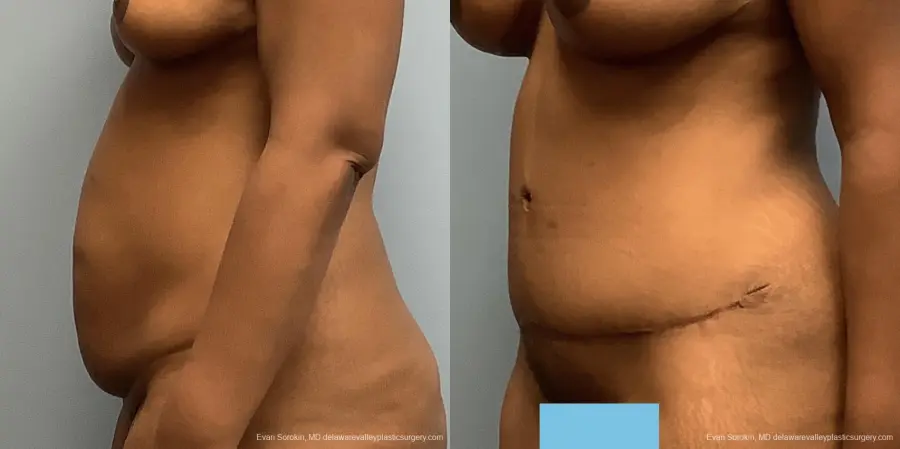 Abdominoplasty: Patient 33 - Before and After 3