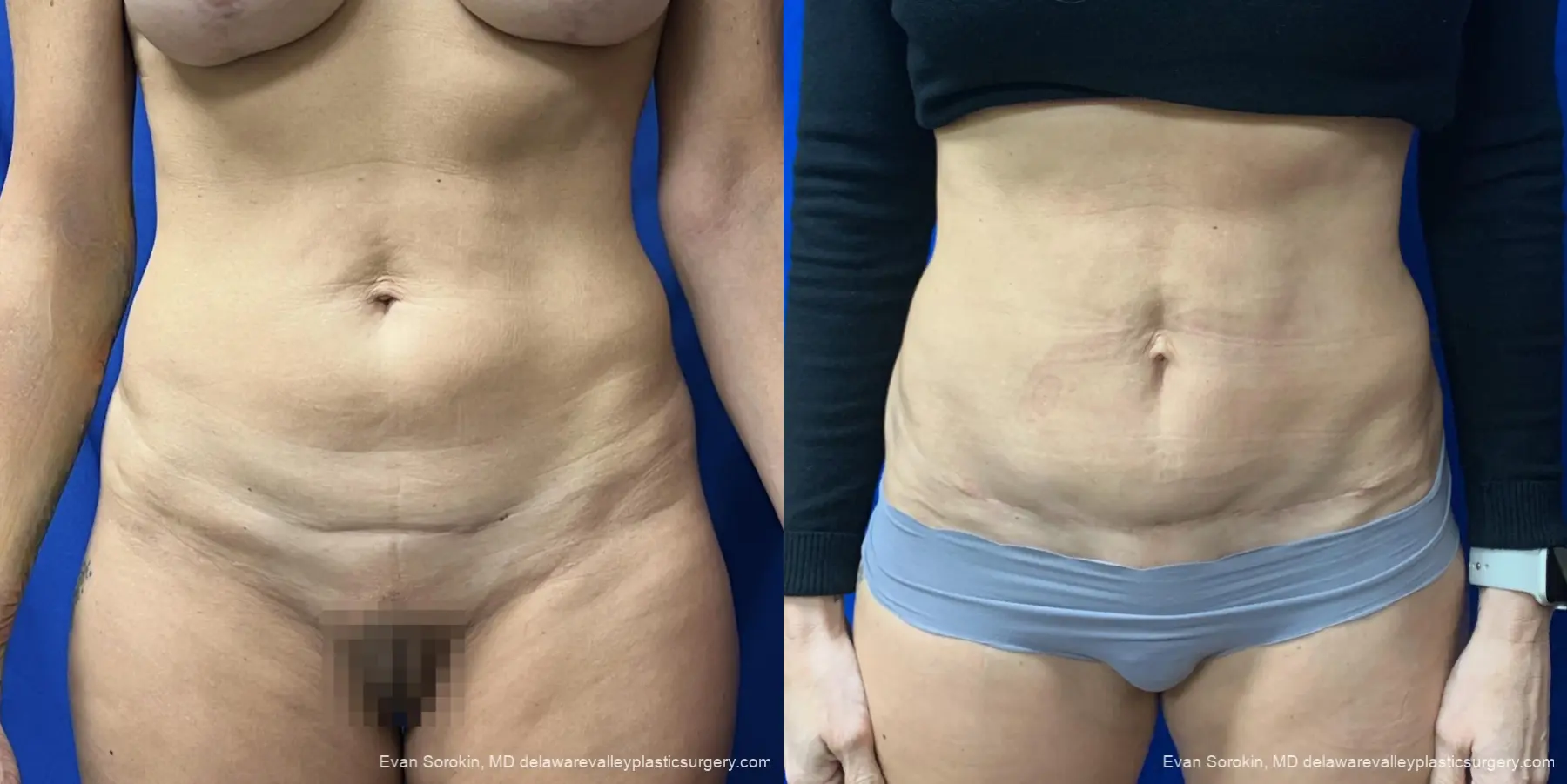 Abdominoplasty: Patient 46 - Before and After 1