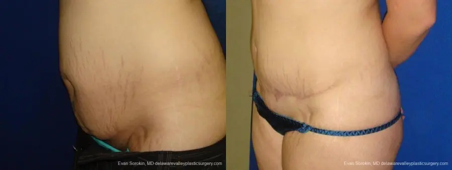 Philadelphia Abdominoplasty 9473 - Before and After 4