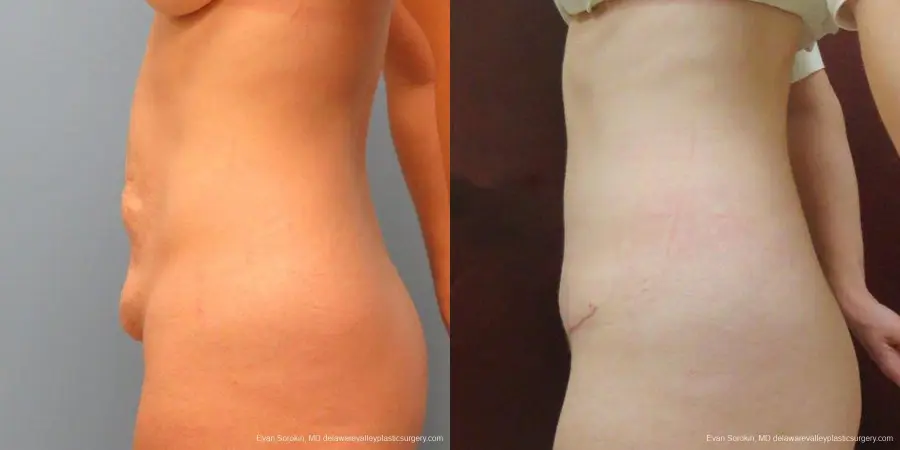 Philadelphia Abdominoplasty 9465 - Before and After 5