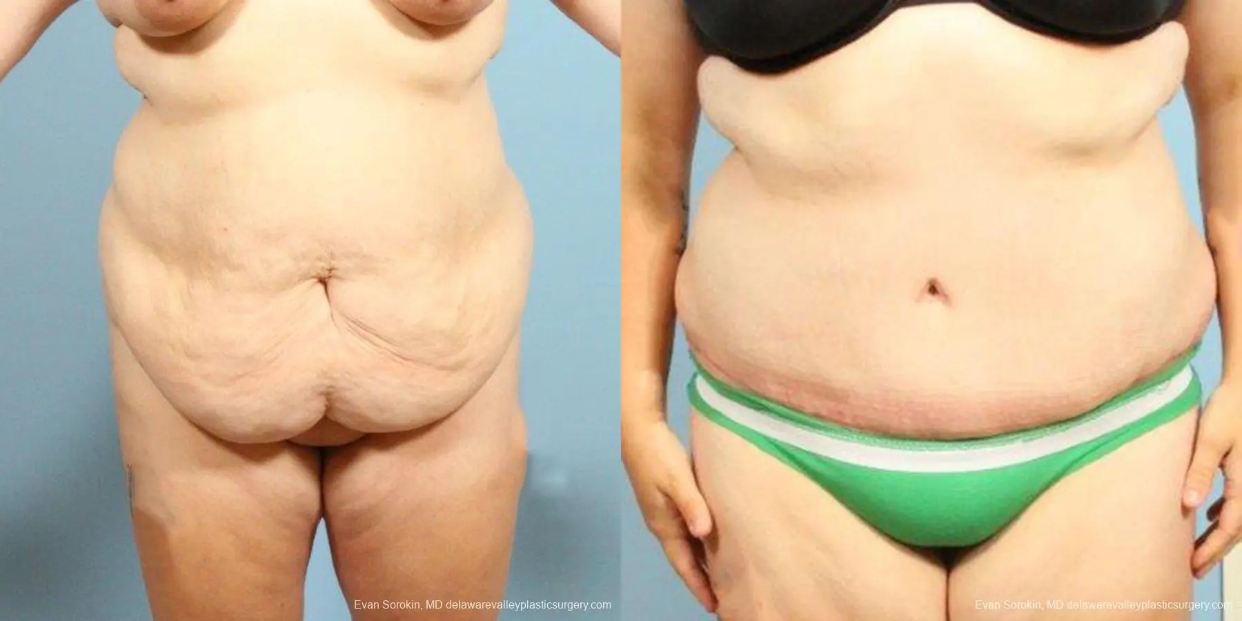 Philadelphia Abdominoplasty 9466 - Before and After 1