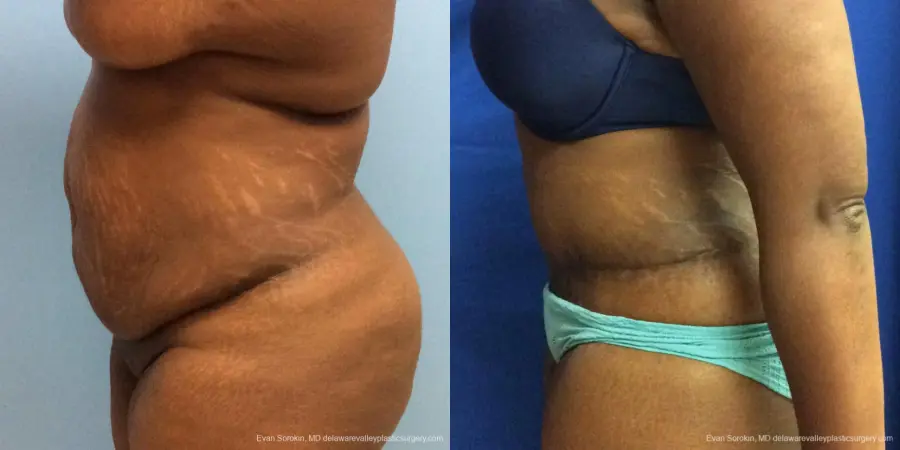 Philadelphia Abdominoplasty 10817 - Before and After 5