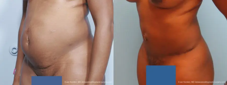 Philadelphia Abdominoplasty 9339 - Before and After 4
