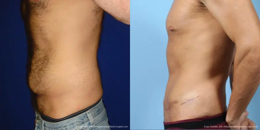 Philadelphia Abdominoplasty 9468 - Before and After 5
