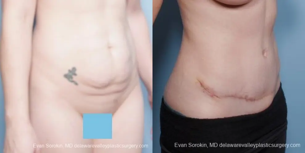 Philadelphia Abdominoplasty 8681 - Before and After 2