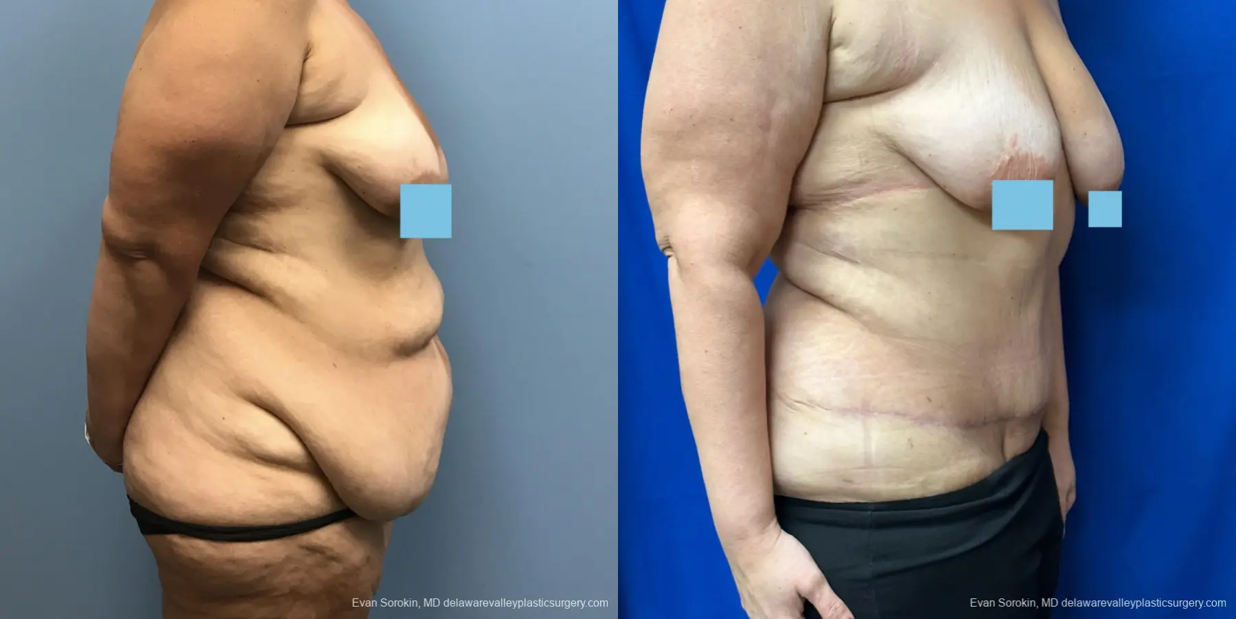 Abdominoplasty: Patient 37 - Before and After 2
