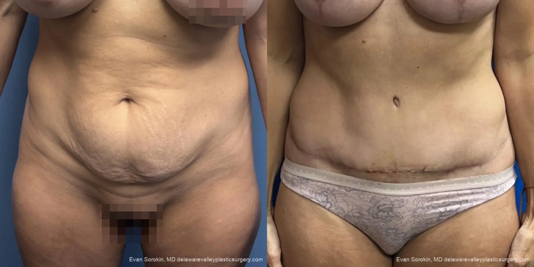 Abdominoplasty: Patient 44 - Before and After 1