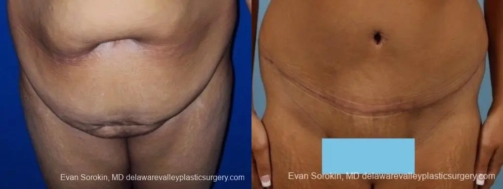 Philadelphia Abdominoplasty 8700 - Before and After 1