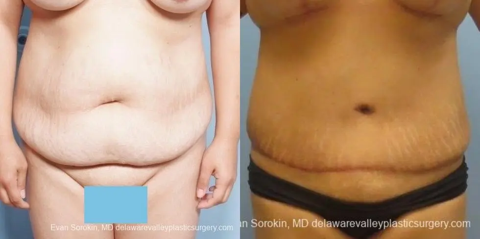 Philadelphia Abdominoplasty 8678 - Before and After 1
