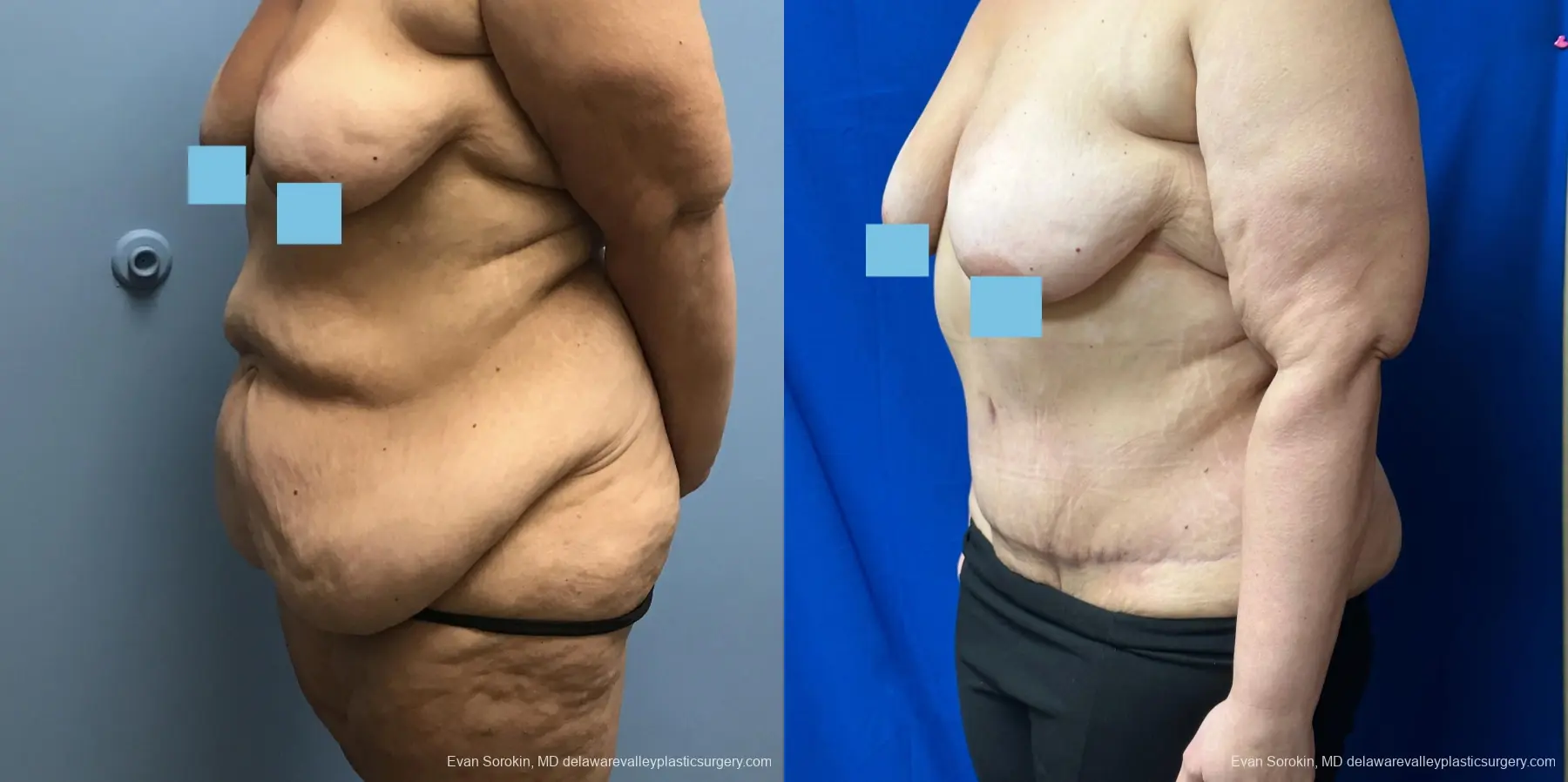Abdominoplasty: Patient 37 - Before and After 3