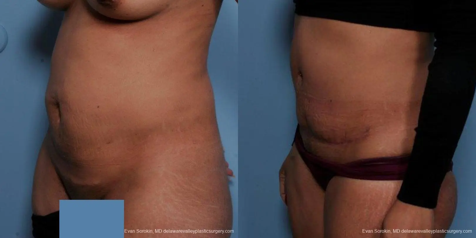 Philadelphia Abdominoplasty 9479 - Before and After 4