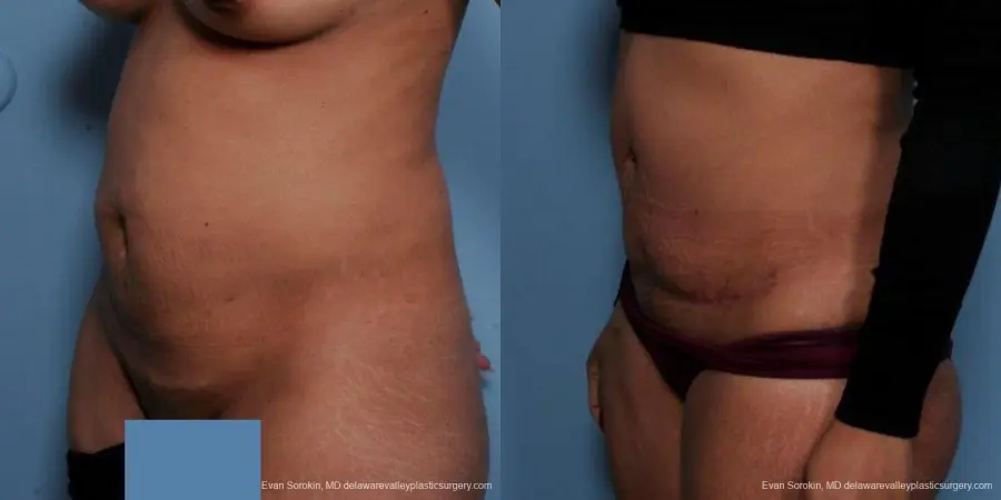 Philadelphia Abdominoplasty 9479 - Before and After 4