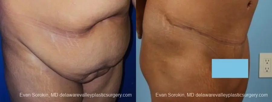 Philadelphia Abdominoplasty 8700 - Before and After 2