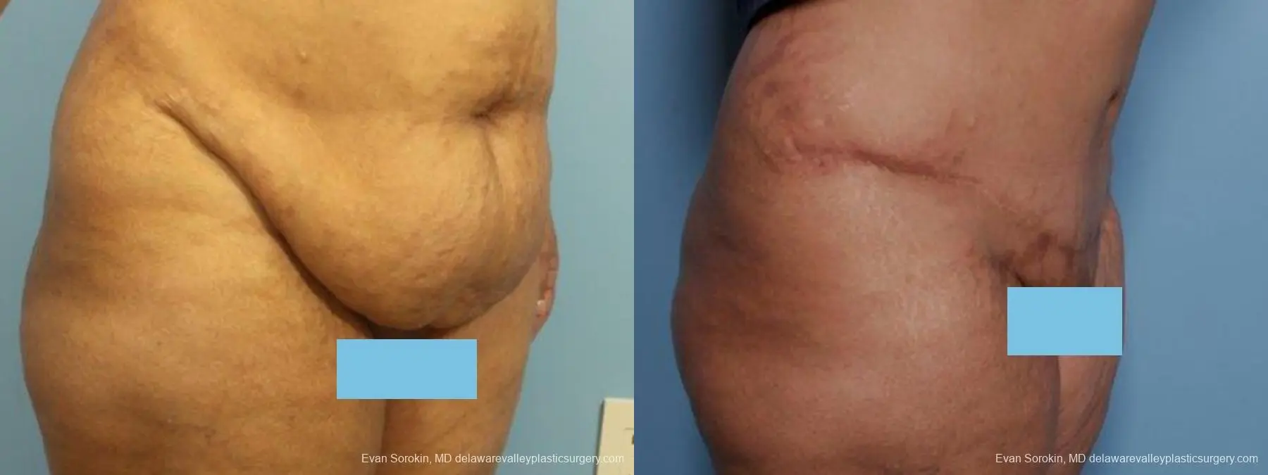 Philadelphia Abdominoplasty 9462 - Before and After 2