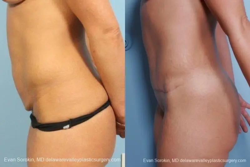 Philadelphia Abdominoplasty 8698 - Before and After 3