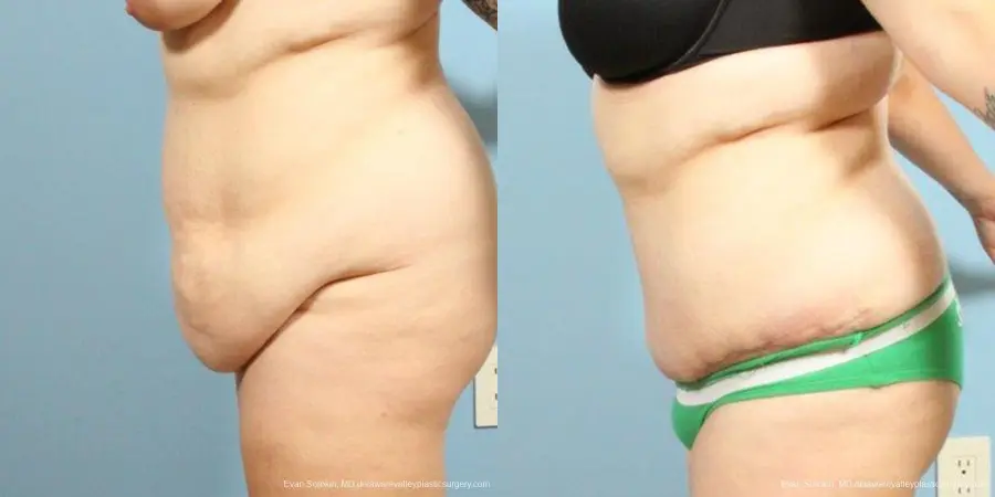 Philadelphia Abdominoplasty 9466 - Before and After 4