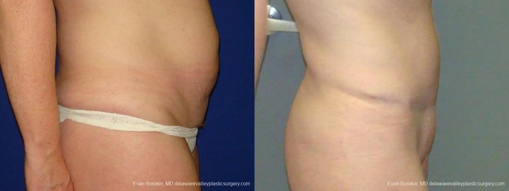 Philadelphia Abdominoplasty 9474 - Before and After 3