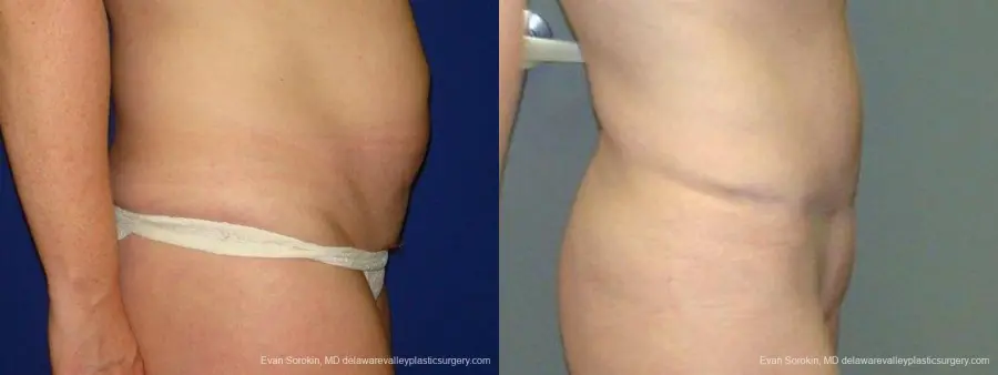 Philadelphia Abdominoplasty 9474 - Before and After 3