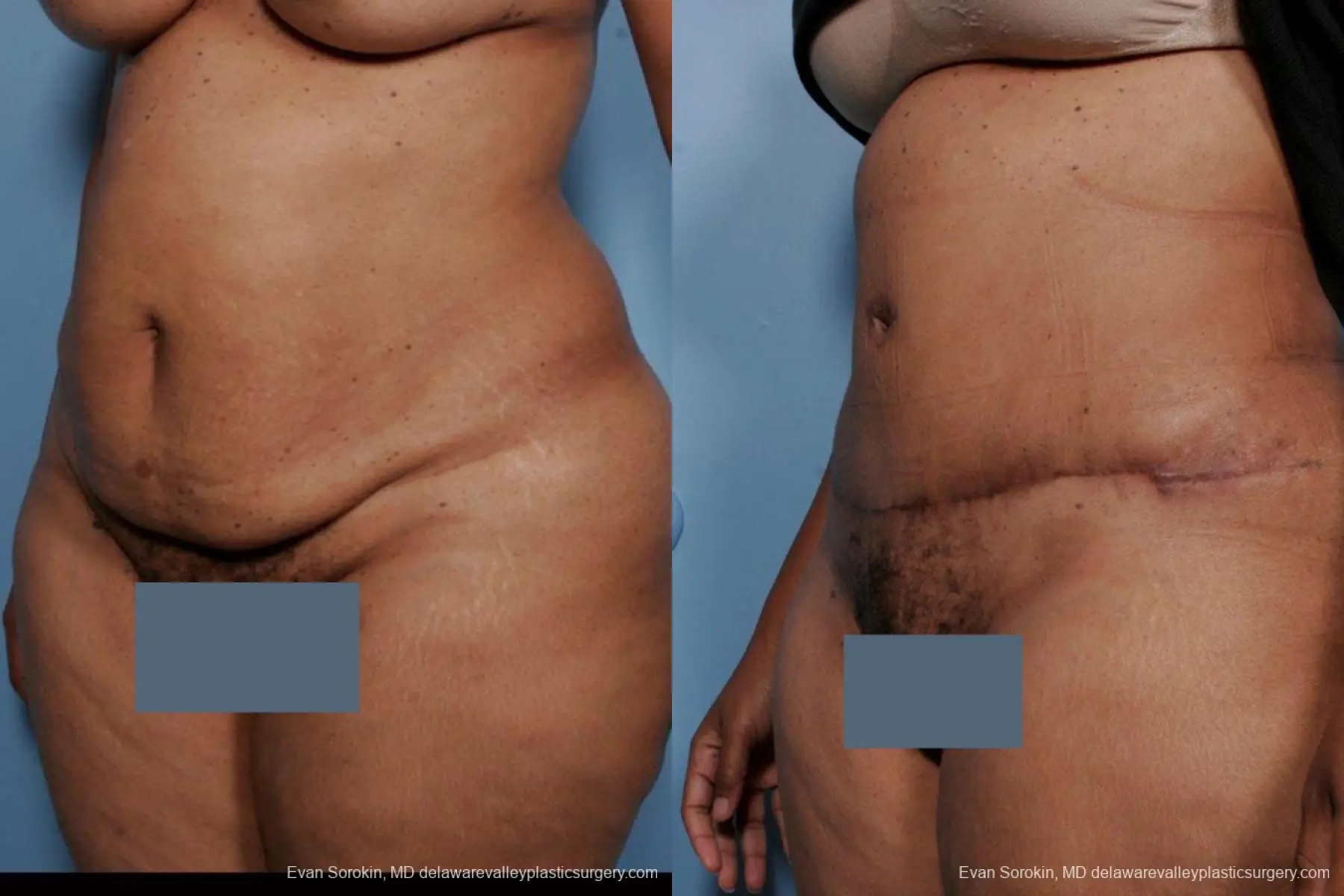 Philadelphia Abdominoplasty 9461 - Before and After 4