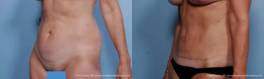 Philadelphia Abdominoplasty 9376 - Before and After 4
