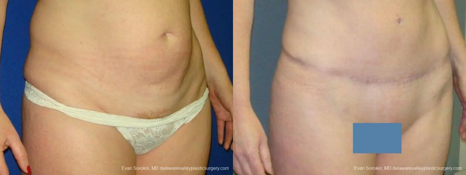 Philadelphia Abdominoplasty 9474 - Before and After 2