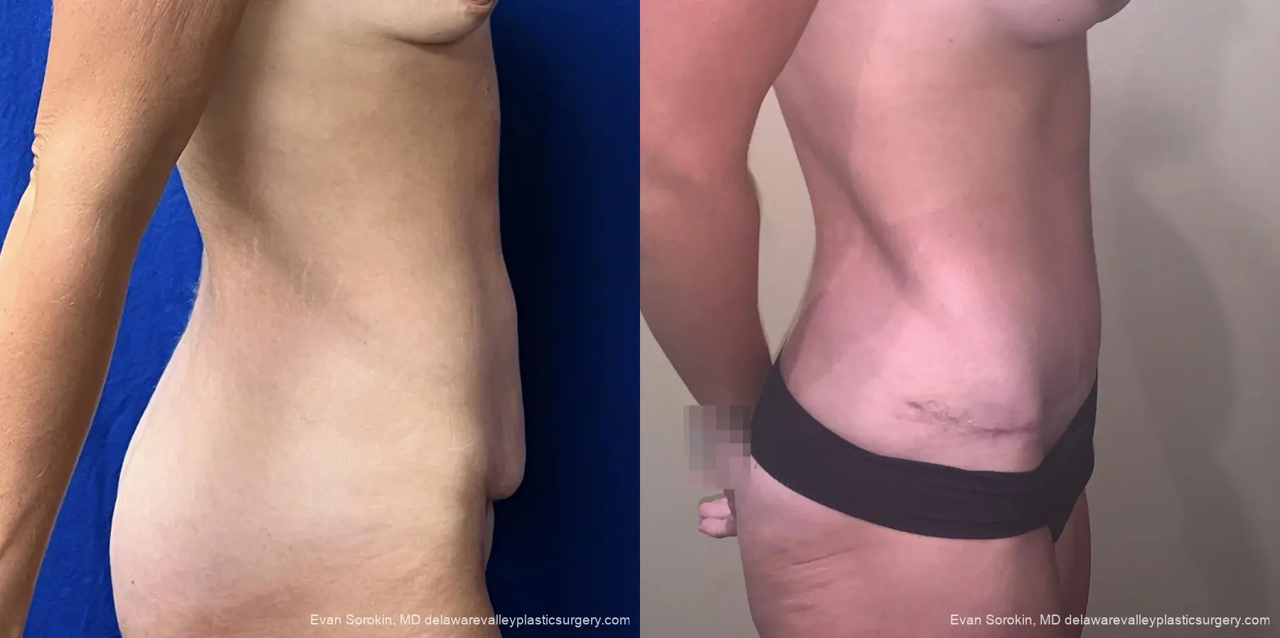 Abdominoplasty: Patient 3 - Before and After 3