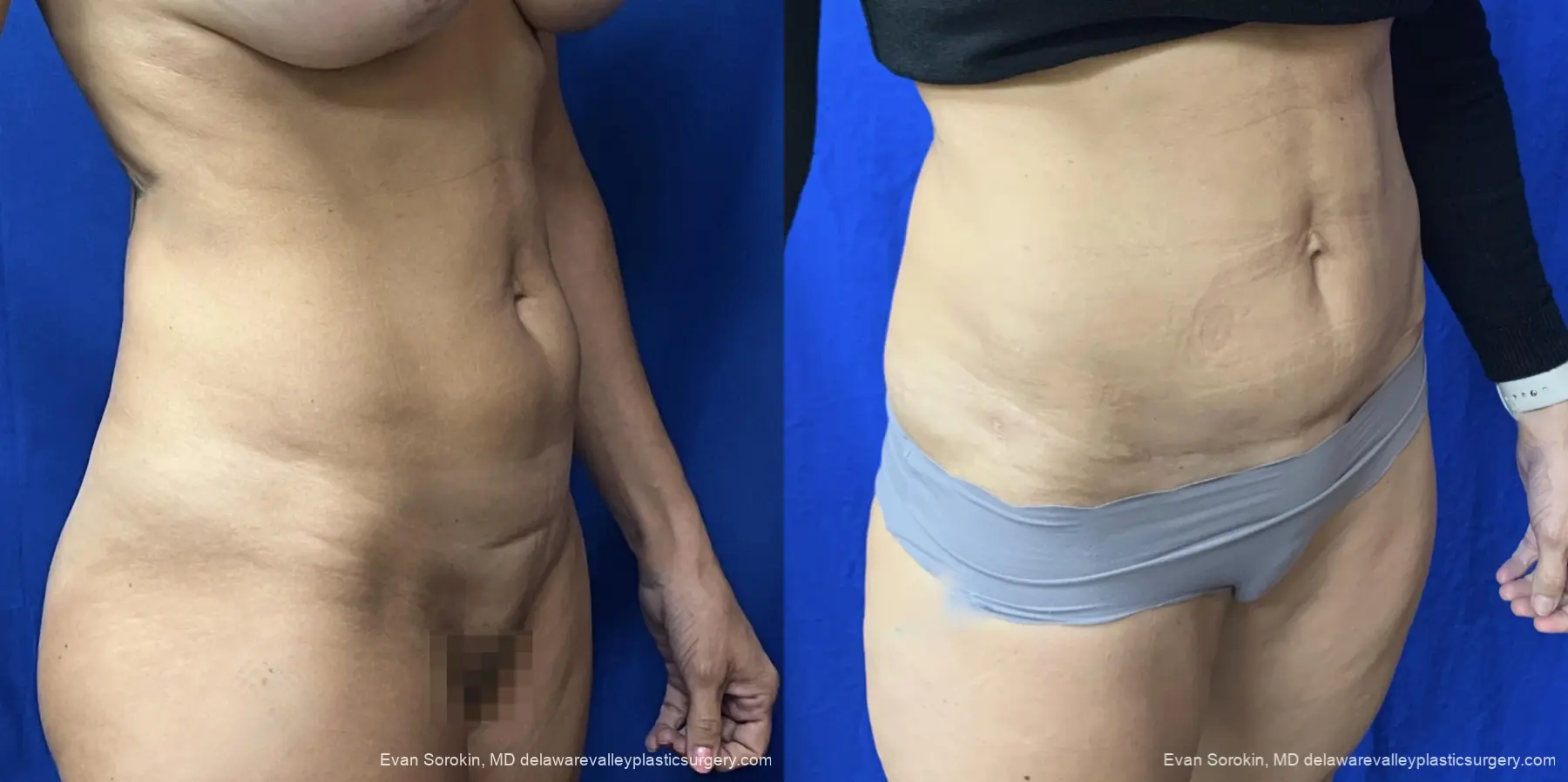 Abdominoplasty: Patient 46 - Before and After 2