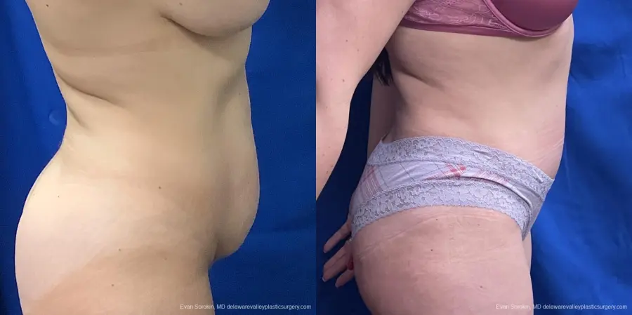 Abdominoplasty: Patient 36 - Before and After 3
