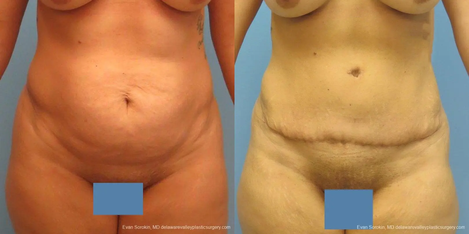 Philadelphia Abdominoplasty 9478 - Before and After 1