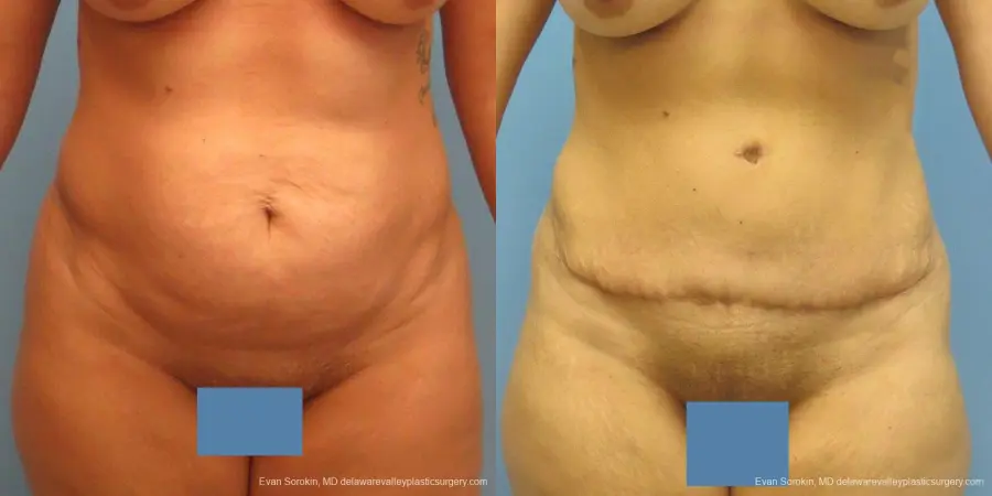 Philadelphia Abdominoplasty 9478 - Before and After 1