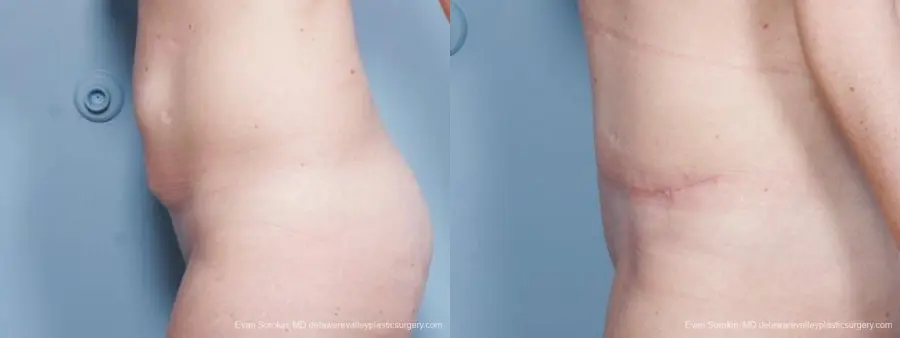 Philadelphia Abdominoplasty 9476 - Before and After 5