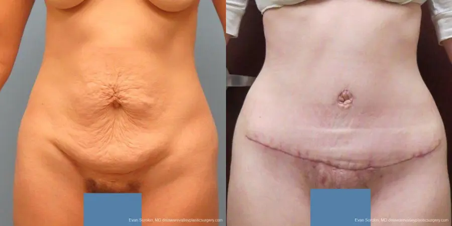 Philadelphia Abdominoplasty 9465 - Before and After 1