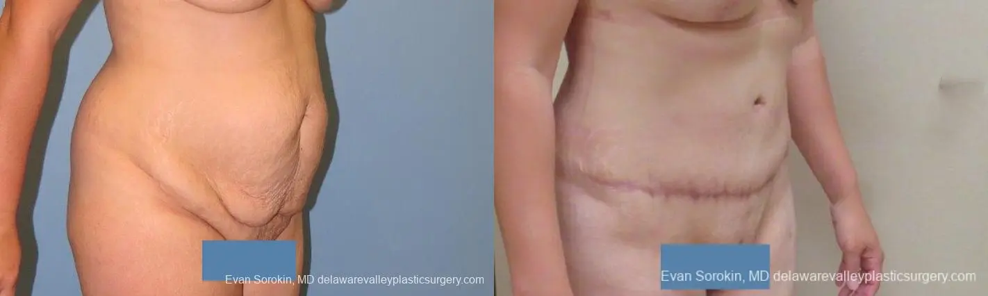 Philadelphia Abdominoplasty 10122 - Before and After 2