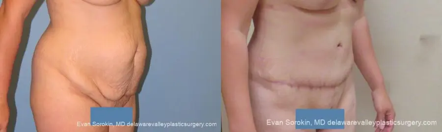 Philadelphia Abdominoplasty 10122 - Before and After 2