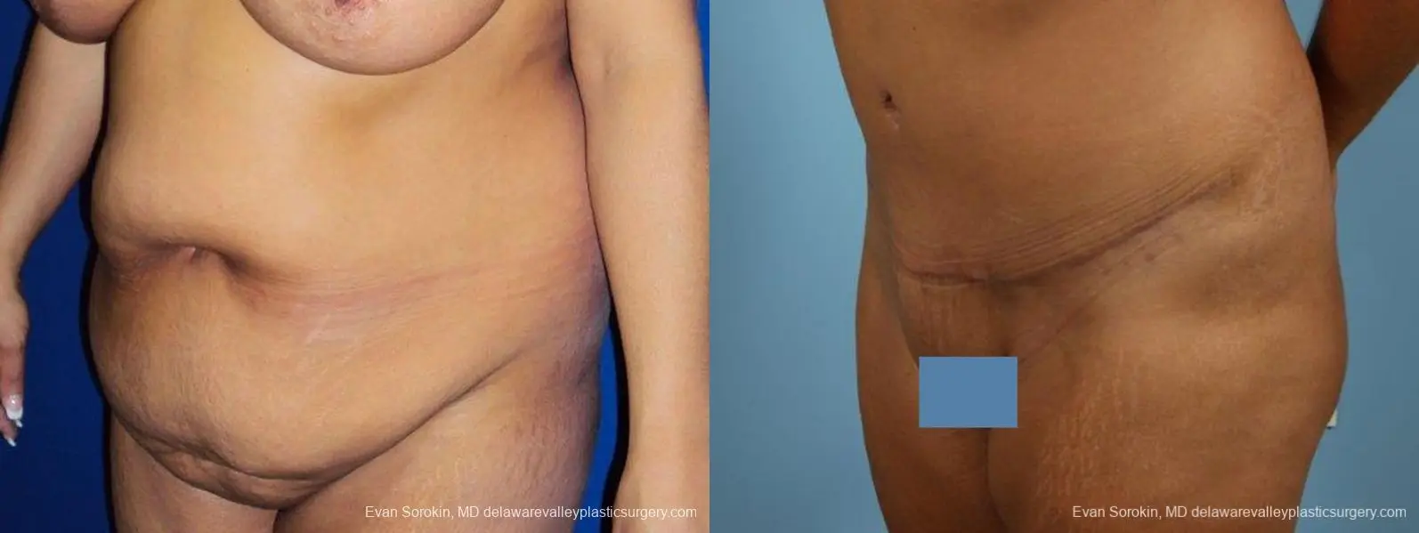 Philadelphia Abdominoplasty 9471 - Before and After 4