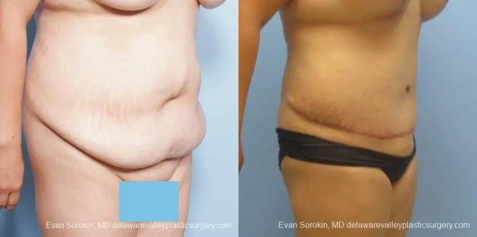Philadelphia Abdominoplasty 8678 - Before and After 2