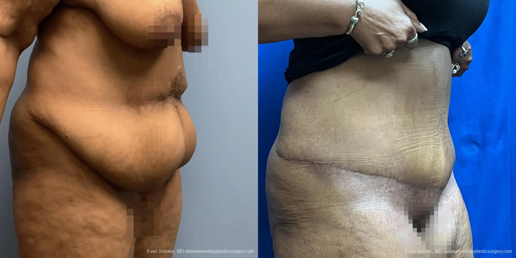 Abdominoplasty: Patient 38 - Before and After 2