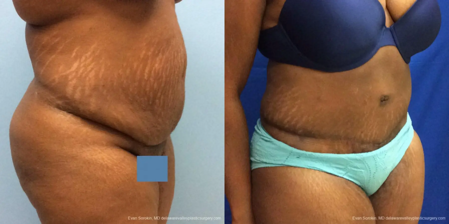 Philadelphia Abdominoplasty 10817 - Before and After 2