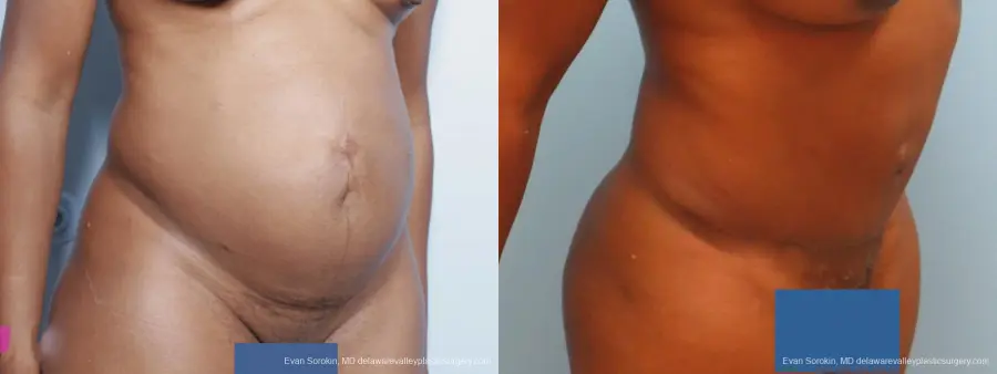 Philadelphia Abdominoplasty 9339 - Before and After 2