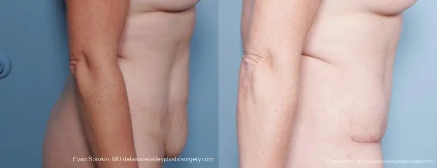 Philadelphia Abdominoplasty 9315 - Before and After 5