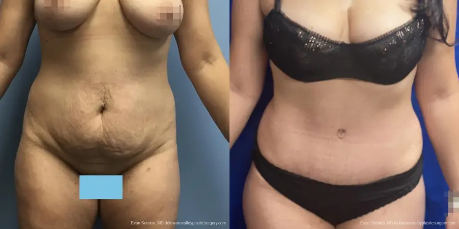 Abdominoplasty: Patient 35 - Before and After 1